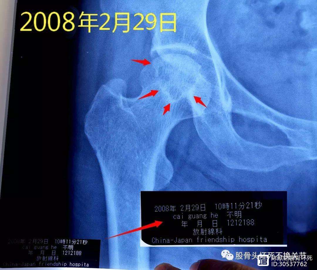 人工骨头医保报销多少(人工骨头医保报销多少比例) 人工骨头医保报销多少(人工骨头医保报销多少比例)